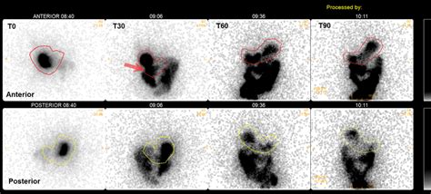 Anterior And Posterior Images Of The Solidmeal Gastric Emptying