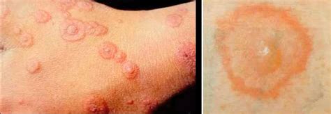 Erythema multiforme - Pictures, Treatment, Symptoms, Causes