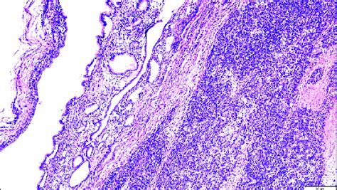 On The Right Side Sex Cord Stromal Tumor With Equal Numbers Of Download Scientific Diagram