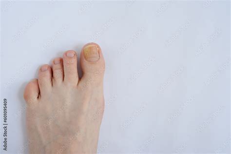 Toenails Affected By Fungal Infection Onychomycosis Stock Photo