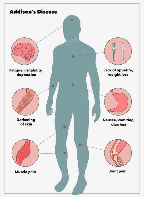 Addison Disease Treatment And Management Point Of Care