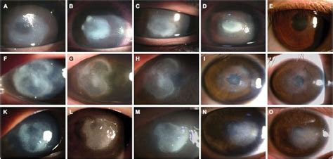 Acanthamoeba Keratitis