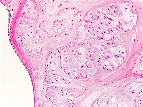 Pathology Outlines Synovial And Tenosynovial Chondromatosis