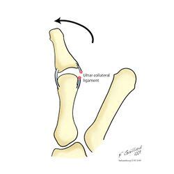 Skier's thumb - Physiopedia