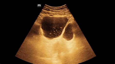 Ub Diverticulum Ultrasound Youtube