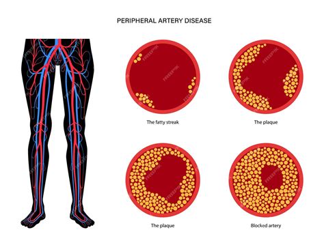 Premium Vector Peripheral Artery Disease