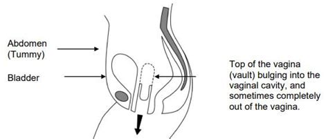 Vaginal Vault Prolapse