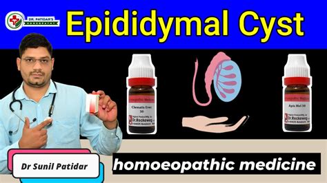 Epididymal Cyst Homeopathic Treatment And Medicines Dr Sunil Patidar Youtube