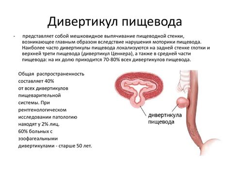 Дивертикулы пищевода - презентация онлайн