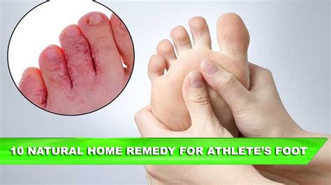 10 Natural Home Remedies For Athlete’s Foot Youtube