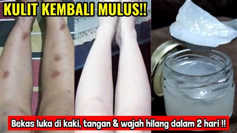 CARA MENGHILANGKAN BEKAS LUKA DI KAKI TANGAN WAJAH KORENGAN CEPAT