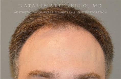 Beverly Hills Hair Restoration Before and After Photos - Los Angeles ...