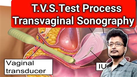 Tvs Test Kya Hota Hai Tvs Test Kab Karna Chahiye Tvs Test Kaise