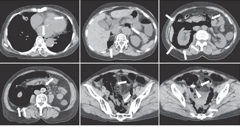 Figure 1 From A Case Of Iatrogenic Perforation Of The Sigmoid Colon With Much Emphysema In