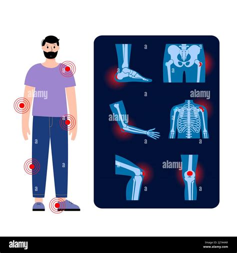 Types Of Bursitis Illustration Stock Photo Alamy