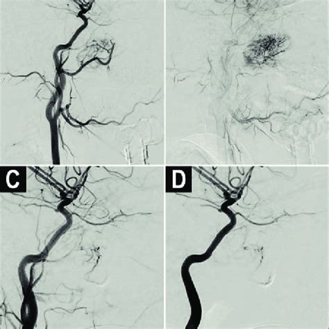 4 Appreciation Of Intraoperative Anatomy Anterior Ethmoidal Artery And Download Scientific