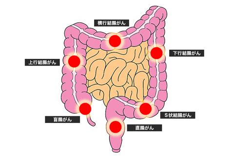 大腸ポリープと大腸がん くるめ病院