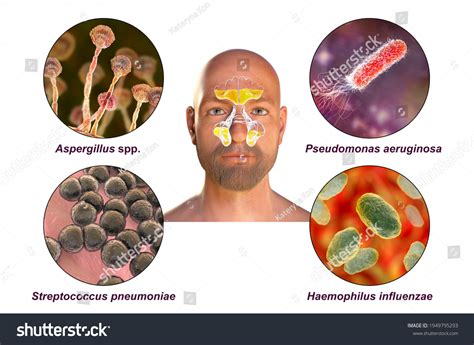 Rhinosinusitis Microorganisms That Cause Sinusitis Fungi Stock