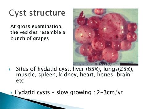 Hydatid Cyst