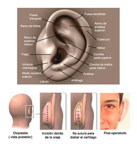 Otoplastia En Valencia Cirug A Est Tica De Orejas Cl Nica Fontana