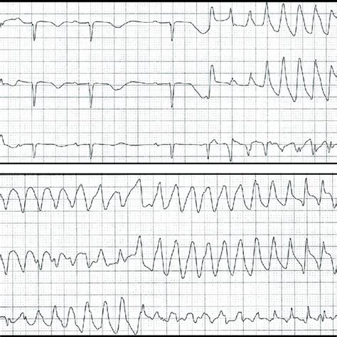 Premature Ventricular Contractions Causes