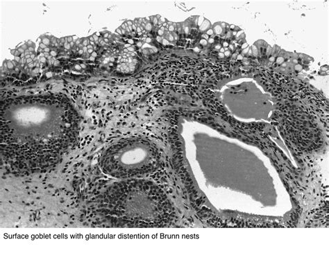 Pathology Outlines Intestinal Metaplasia