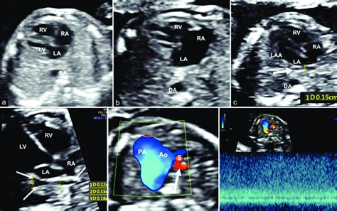 Fetal echocardiography imaging of supracardiac TAPVC to the SVC with... | Download Scientific ...