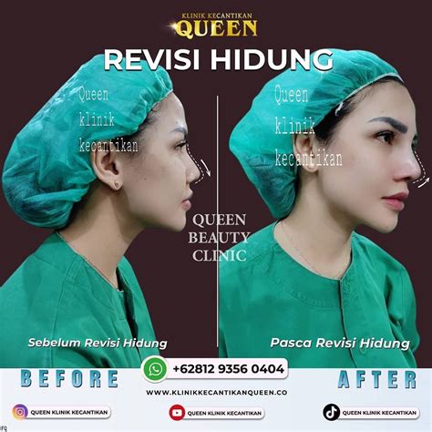 Before After Operasi Hidung Klinik Bedah Plastik Queen