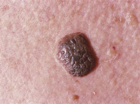 Weird Skin Growths