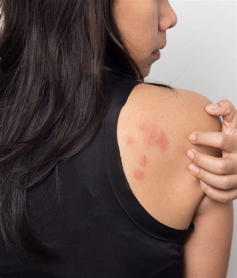 Rashes Hives Mesa AZ Sagebrush Dermatology