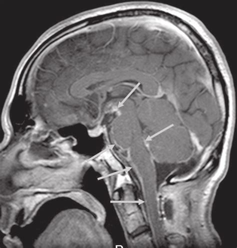 Postcontrast T Weighted Sagittal Magnetic Resonance Image Showing An