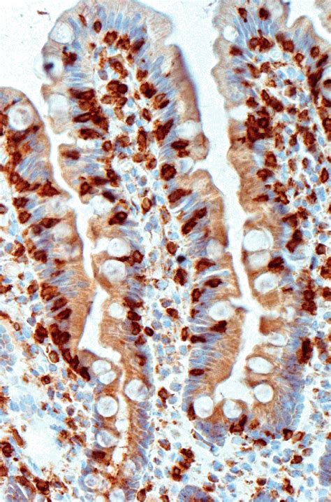 Chapter 15 Coeliac Disease Abdominal Key