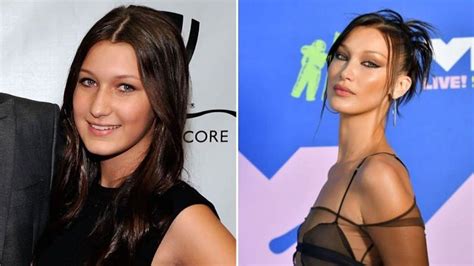 Bella Hadid antes y después de sus operaciones MCAN Health