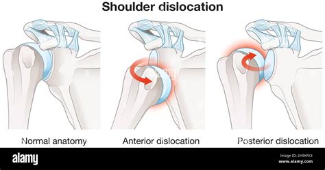 Shoulder Impingement Syndrome Rubbing Rotator Cuff Outline 59 Off