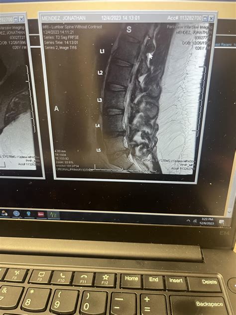 Rate my mri for herniated disc l4 l5 and l5 s1 : r/backpain