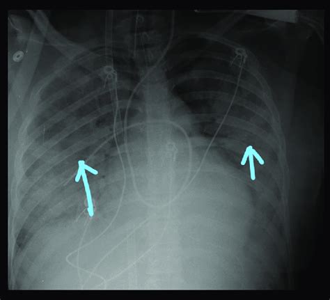 Chest x-ray revealed bilateral lung consolidation concerning for ARDS ...