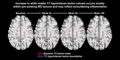 Brain On Twitter Elliott Et Al Report That T1 Weighted Measures Of