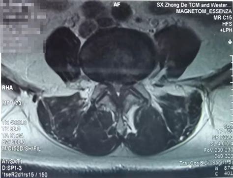 门诊实录：腰椎间盘突出伴腰椎管狭窄，保守治疗无效怎么办 原创 微医（挂号网）