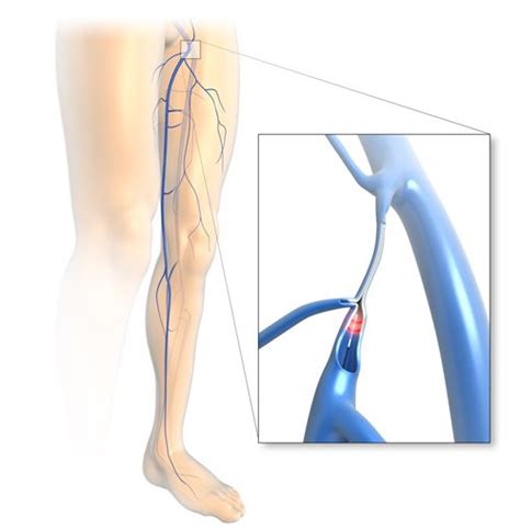 Laser Vein Treatment Evla The Vein And Laser Centre