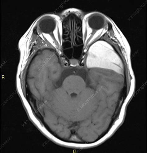 Haemorrhagic Arachnoid Cyst Stock Image C0271573 Science Photo Library