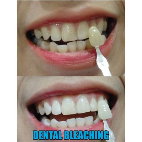 Jual Brillo Dental Voucher Bleaching Pemutihan Gigi Dan Scaling Di