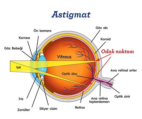 Astigmat Nedir Astigmat Belirtileri Ve Tedavisi