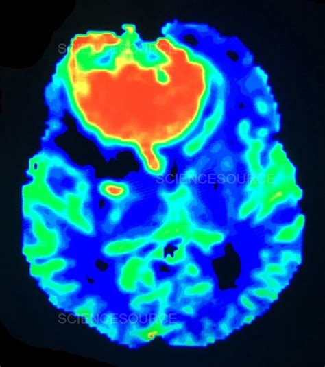 Photograph Large Frontal Meningioma Mri Science Source Images