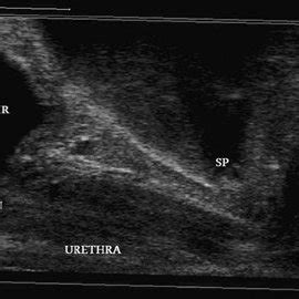 Longitudinal View Of The Urethral Complex Obtained By A