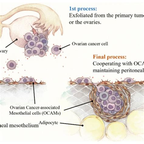 Pdf Ovarian Cancer Associated Mesothelial Cells Transdifferentiation