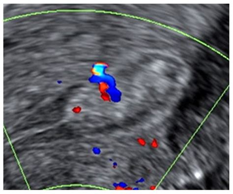 Uterine Polyps Ultrasound