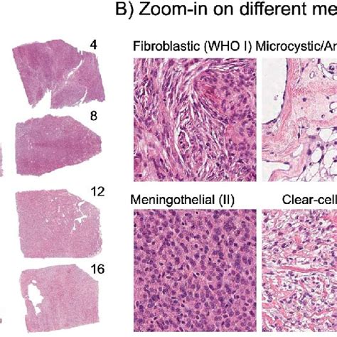 Histology Overview Panel A Shows The Sixteen Meningioma Samples That Download Scientific