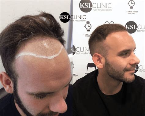 Fue Hair Transplant Fue Hair Restoration Ksl Clinic