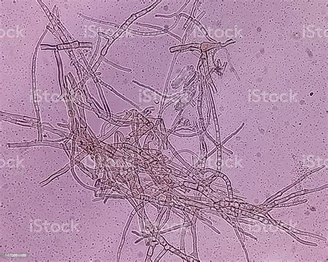 Microscopic Fungi Malassezia Furfur Showing Yeast Cells And Hyphae Dermatophytes Nail Scraping