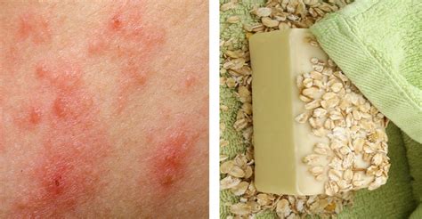 Ease Eczema Itch In Minutes With These Simple Natural Cures Just